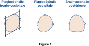 Figure 1 plagiocephalie Figure 1 plagiocephalie