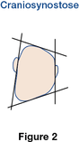 Figure 2 Craniosynostose Figure 2 Craniosynostose